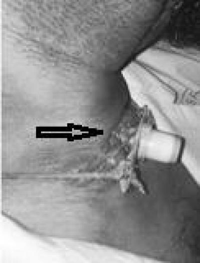 Figure 1: The figure shows a) the patient’s tracheostomy tube protruded anteriorly from stoma due to presence of hypertrophic scar (arrow)