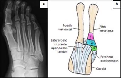 Figure 1: a) Radiograph of fifth metatarsal fracture (Tan et al. 2016). b) Diagram of fifth metatarsal showing related tendons and fractures’ zones