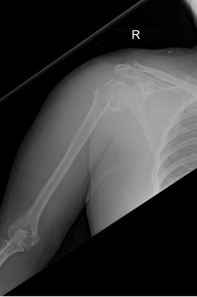 Figure 1: Anteroposterior radiograph of right shoulder: displaced fracture neck of right humerus.