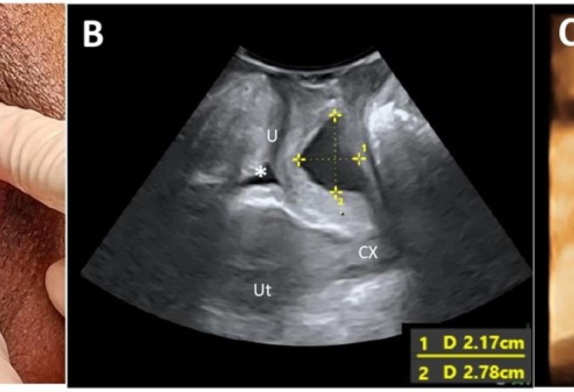 FIGURE 1: (A) A left periurethral mass extending from the left periurethral space to suburethral region measuring 3 cm x 5 cm; (B) Midsagittal view of the pelvic floor showing a cystic mass (*) dorsal to the urethra (U) measuring 2.17 cm x 2.78 cm on translabial perineal ultrasound (TPUS); (C) TPUS view demonstrating a periurethral mass dorsal to the urethra measuring 4.22 cm (width) x 1.99 cm (vertical dimension). (SP: Symphysis pubis; Ut: Uterus; CX: Cervix)