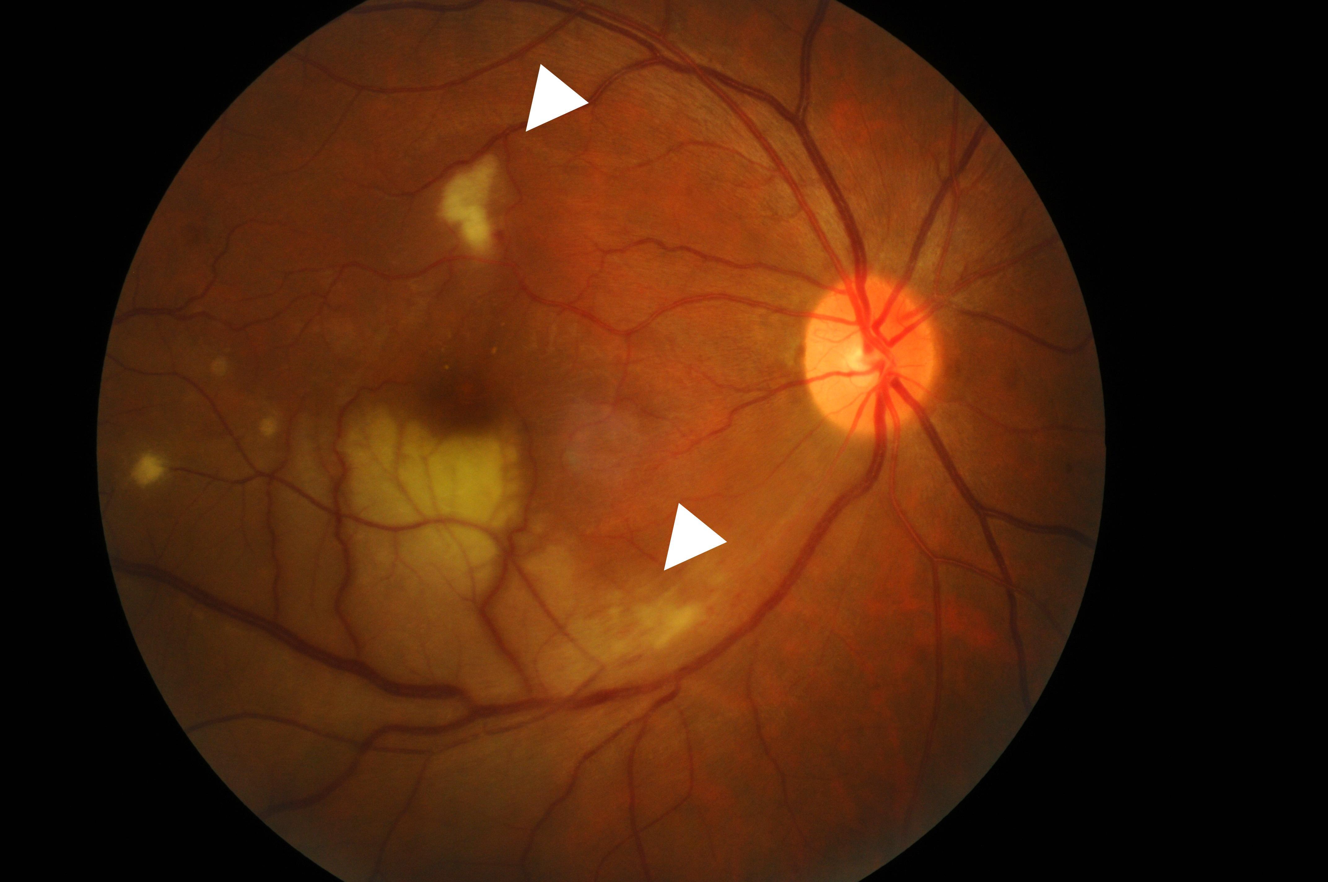 FIGURE 1: Colored fundus photograph of the right eye showed a BRAO involving the inferotemporal arcade (inferior arrow) with surrounding pallid retinal edema associated with an area of focal retinitis (superior arrow)