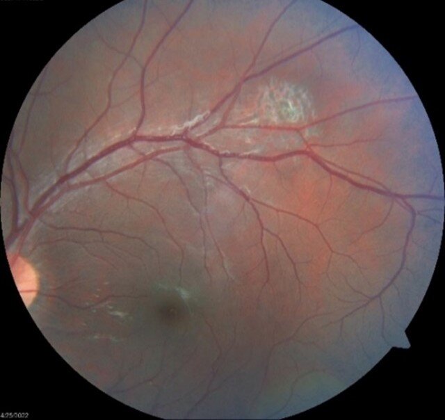 Post-treatment fundus of left eye
