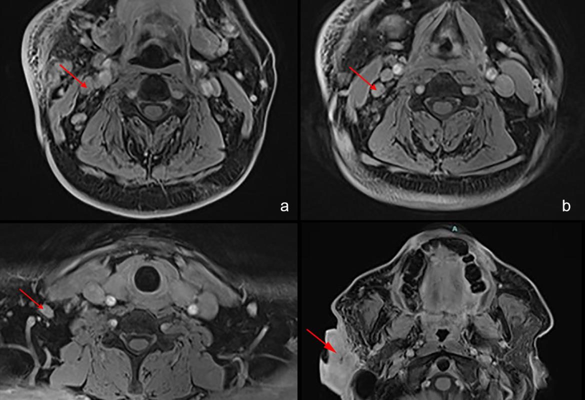 FIGURE 2: MRI images showed (a-c) enlarged and enhancing lymph nodes at levels 2, 3, and 4 of the right cervical neck regions; (d) lobulated soft tissue mass measuring 2.6 cm x 4.9 cm x 6.3 cm in the right pre- and postauricular space