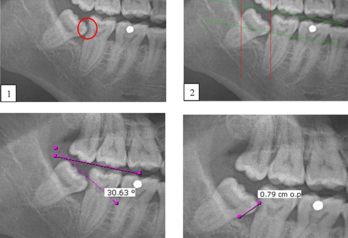 Caries and impacted MTM impaction: (1) Distal caries on MSM; (2) The depth and space of MTM was determined by the Pell & Gregory classification method; (3) The Shiller classification applied in determining the angulation of impacted third molar; (4) The distance between the distal CEJ of the MSM and mesial CEJ of the MTM was calculated as described in Leone classification