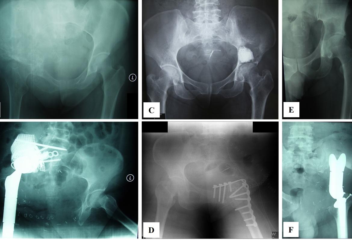 Reconstruction techniques following internal hemipelvectomy for periacetabular chondrosarcoma. Preoperative and postoperative plain radiographs demonstrated three different reconstructive approaches: (A, B) Modified total hip replacement (Case #2), (C, D) hip transposition with fusion (Case #4), and (E, F) saddle endoprosthesis (Case #6)