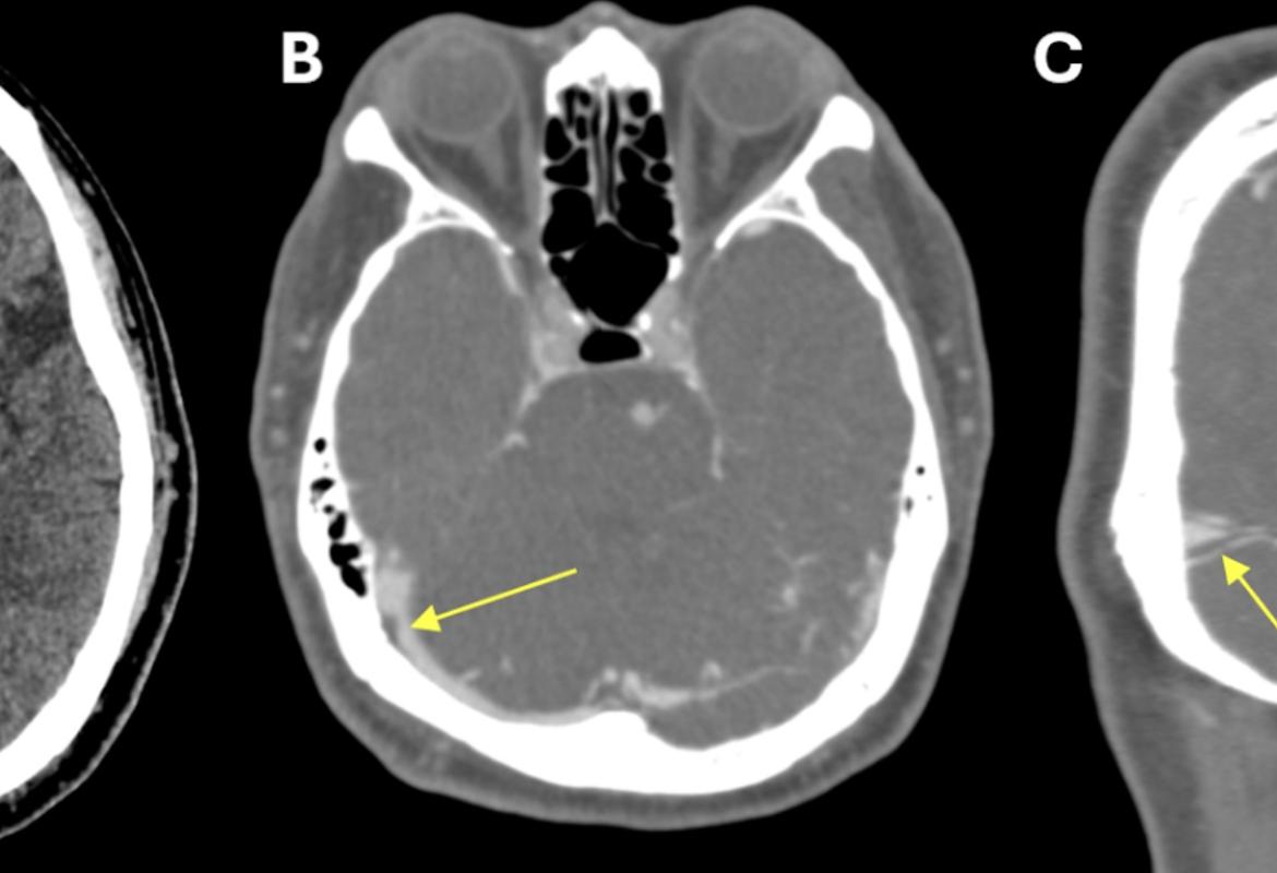 FIGURE 1: (A) Non-contrast CT brain demonstrated acute focal hemorrhage at the right occipital lobe withperihemorrhagic hypodensity extending to the right parieto-occipital region; (B) Subsequent CT venography in axial plane revealed thin linear isodensity within the right transverse sinus; (C) CT venography in coronal plane confirmed the filling defect within the right transverse sinus, consistent with thrombus