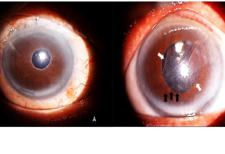 Anterior segment photos showing (A) right eye clear cornea, presence of pseudoexfoliative materials over the pupillary margin, a surgical peripheral iridectomy and a flat conjunctival bleb indicating a failed trabeculectomy, with no sign of vortex keratopathy as compared to (B) whorl-like opacities (white arrows) merging into a horizontal line (black arrows) in the left eye which was very characteristic of vortex keratopathy