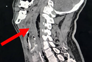 Initial computed tomograpgy neck showed extensive multiloculated gas containing collection seen at retropharyngeal region (red arrow) from the level of oropharynx in sagittal section