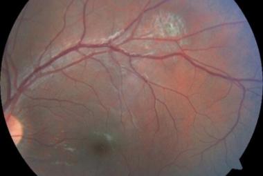Post-treatment fundus of left eye