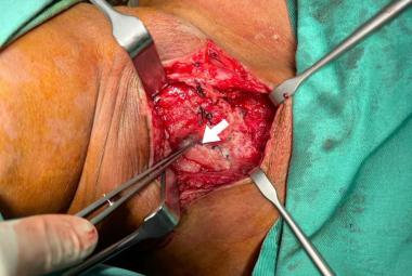 FIGURE 1: Neck re-exploration revealing intact suture at the site of primary repair