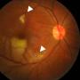 FIGURE 1: Colored fundus photograph of the right eye showed a BRAO involving the inferotemporal arcade (inferior arrow) with surrounding pallid retinal edema associated with an area of focal retinitis (superior arrow)