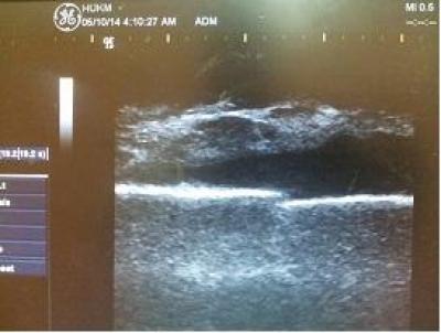 Figure 1: Ultrasoud image of fracture 