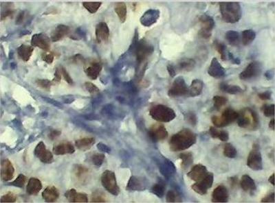 Figure 1: Positive (IHC) detection of p53 protein (A-D). Tissue with crisp brownish nuclear precipitatation of p53 protein overexpression; (A) S0045164, magnification x40, (B) S004776, magnification x10. (C) S0048960, magnification x10, and (D) S0047962, magnification x40