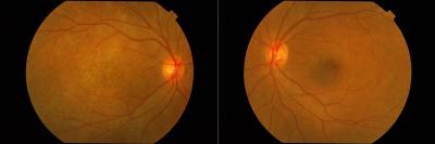 Figure 1: Color fundus photographs of right and left eyes. Right fundus showed multiple deep hypopigmented lesions with a dull macula. Left fundus was normal.