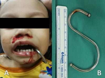 Figure 1: (A) The child with metal hook in situ when presented to the emergency department. (B) The metal hook that was successfully removed.