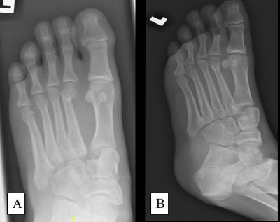 Figure 1: (A) Anteroposterior view and (B) oblique view of left foot plain radiograph showing Lisfranc injury of the left foot