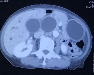 Figure 1: Computed tomography showing 3 homogenously enhanced lesions on axial view