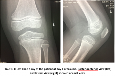 Figure 1: Left knee X-ray of the patient at day 1 of trauma. Posterioanterior view (left) and lateral view (right) showed normal x-ray