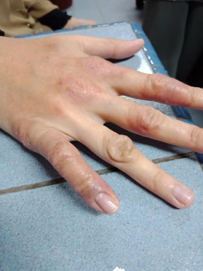 FIGURE 1: Glazed, dry and scalded epidermis observed on the dorsum of right hand, prominent over the metacarpophalangeal joints and proximal interphalangeal joints