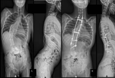 Figure 1: (A) Whole spine radiograph showing thoracolumbar curve with Cobb’s angle of 80˚, apex at T11 and failure of vertebral segmentation at multiple levels. (B) Improvement in Cobb’s angle of 56˚ with improvement in lung volume post-surgery.