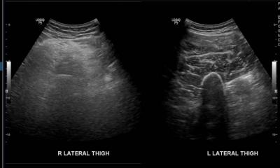 Figure 1: Ultrasound comparing the right and left thigh. Ultrasound showed muscles at lateral aspect of right thigh are heterogeneously hyperechoic. No collection seen at subcutaneous tissue or intramuscularly.