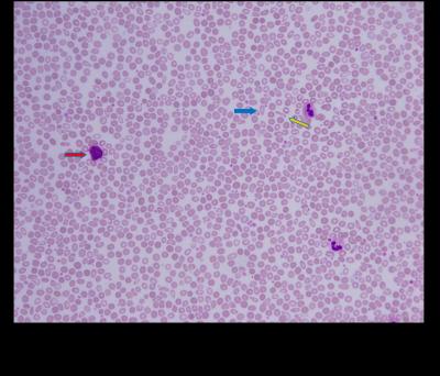 Figure 1: Peripheral blood smear (Wright's stain, 400x magnification) showed hypochromic microcytic cells with anisopoikilocytosis, tear drop (blue arrow), and pencil cells (yellow arrow). Basophils were easily seen (red arrow).