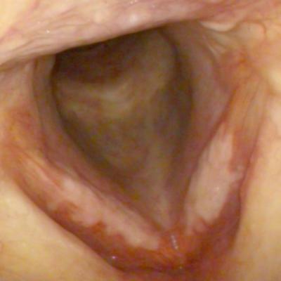 FIGURE 1: Video-endoscope of larynx depicted leucoplakia at the anterior two-thirds of bilateral vocal folds