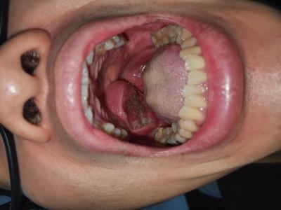 FIGURE 1: The well circumscribed mass confined to the soft palate, but the mucosal surface became ulcerated after performing incisional biopsy