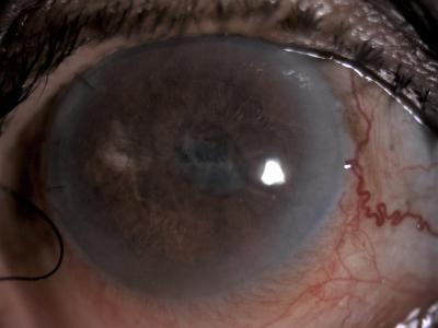 Figure 1: Prior to intracameral rtPA shows fibrin over the pupil and intraocular lens causing seclusion pupillae, iris bombe is not clearly seen in this photo but anterior chamber was very shallow with complete iridocorneal touch 360 degree