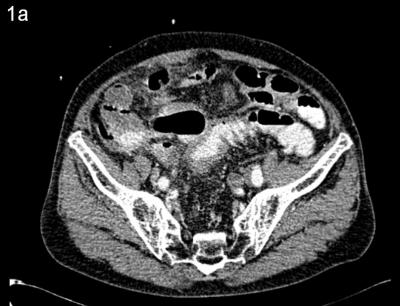 Figure 1a: Contrast enhanced computed tomography showing diffuse thickening of rectosigmoid colon 