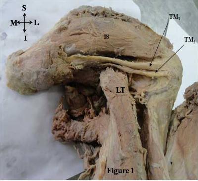 Figure 1: Depicts postero-inferior view of right scapular region showing variant teres minor muscle (IS=Infraspinatus muscle, TM1=Superior tendinous part of teres minor muscle, TM2=Inferior tendinous part of teres minor muscle, TM=Teres minor muscle, LHT= Long head of triceps brachii, TMJ: Teres major muscle)