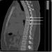 A Case of Missed Thoracic Fracture Masquerading as Intra-Abdominal Injury