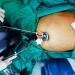 Single Incision Laparoscopic Bariatric Surgery: Challenging the Conventional