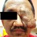Left Facial Tumour. What Is It?