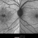 Figure 3: IR of right and left eyes. IR of right eye showed multiple hyper-reflective areas at the macula region. Left eye was normal.