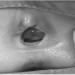 Figure 3: Examination under anesthesia found a doughnut-shaped mass protruding from the urethral orifice which consistent with urethral prolapse.