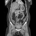 Figure 1: Free fluid noted in the pelvis, perihepatic region, perisplenic region and along the para-colic gutter.