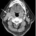 FIGURE 2: Axial CT image at a more inferior level of the palatine tonsils showed an enlarged right level IIA adenopathy (white arrow), abutting the right sternocleidomastoid muscle posterolaterally. No encasement of the ipsilateral carotid sheath was found. Few smaller subcentimetre nodes may be observed at the adjacent right level IB in this image 