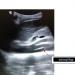 Figure 1: Bedside USG Abdomen in ED shows visualization of an intimal flap (red arrow)