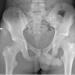 Figure 1: Plain pelvis radiograph showing avulsion fracture of right anterior superior iliac spine (white arrow).