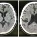 Figure 1: Plain CT brain image of the patient