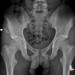 Figure 2:  Plain pelvis radiograph two months post trauma showing callus formation over avulsed right anterior iliac spine fragment (white arrow).