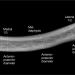 Clavicular measurements from radiograph.