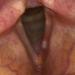 FIGURE 2: Video-endoscope of larynx depicted leucoplakia at the anterior one-third of right vocal folds with erythema over anterior two-thirds