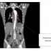 Figure 3 : CT Abdomen coronal view