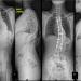 Figure 3: (A) Whole spine radiograph showing thoracolumbar curve with Cobb’s angle of 76˚, and failure of vertebral segmentation at multiple levels. (B) Post spinal instrumentation surgery showed improvement of Cobb’s angle to 50˚.