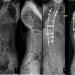 Figure 5: (A) Whole spine radiograph showing thoracic curve with Cobb’s angle of 95˚, and failure of vertebral segmentation at multiple levels. (B) Post spinal instrumentation surgery showed improvement of Cobb’s angle to 53˚.