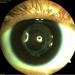 Figure 5A: 3 months post cataract extraction and intraocular lens implantation with clear cornea