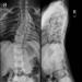 Figure 6: Whole spine radiograph revealing Cobb’s angle of 26˚ and failure of segmentation of multiple thoracic vertebrae. 