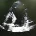 Bedside echocardiogram showed dilated left ventricle (LV) on a apical 4-chamber view.